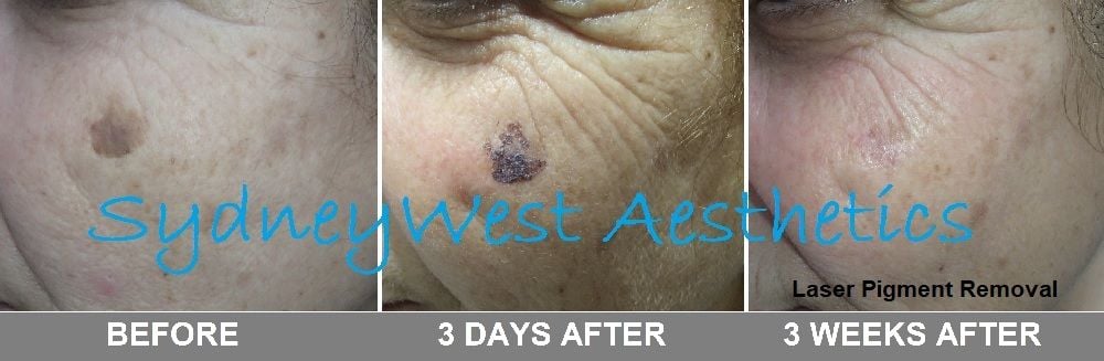 Pigmentation Image -5c8094b0b81a1